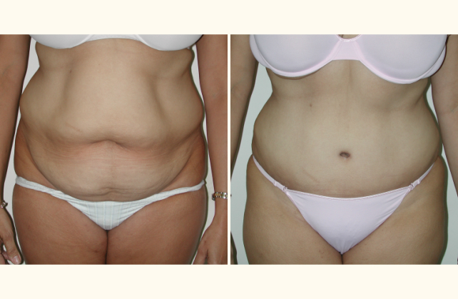 body tummy tuck 1350497749238