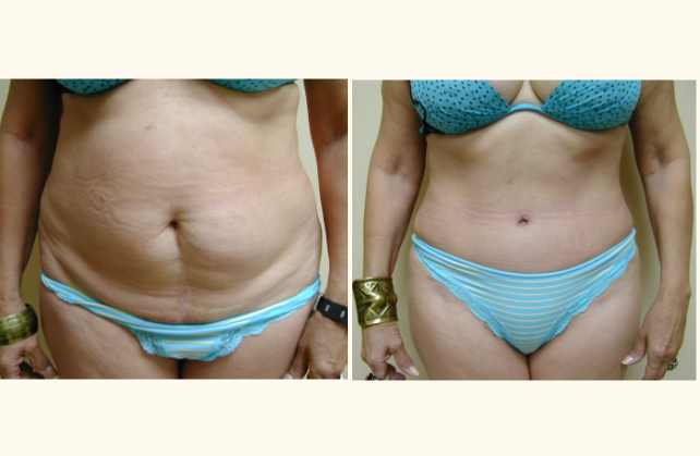 body tummy tuck 1350497858238