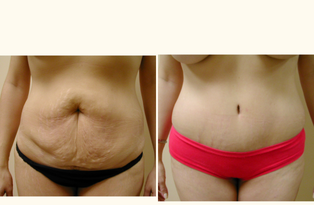 body tummy tuck 1415576742065