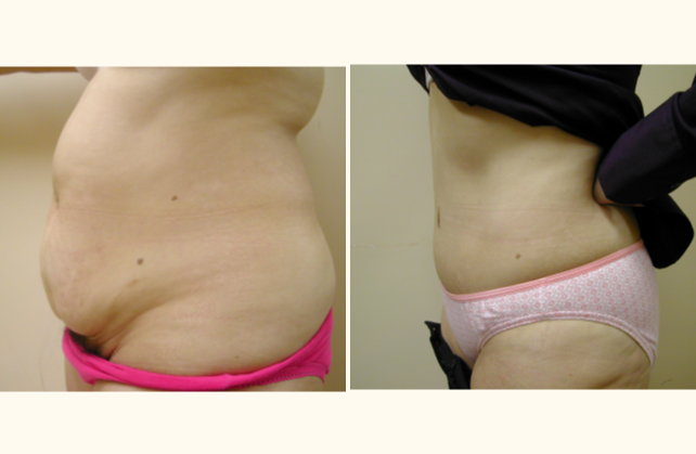 body tummy tuck 1415849697959