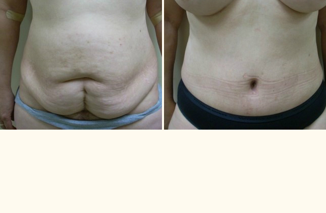 body tummy tuck 1505509146328