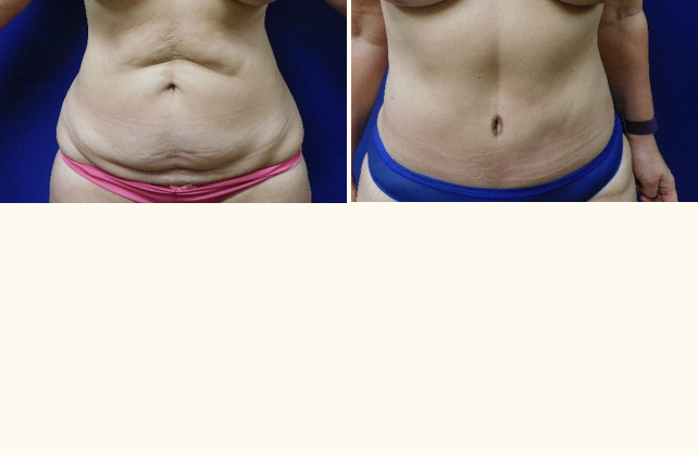 body tummy tuck 1505509182320