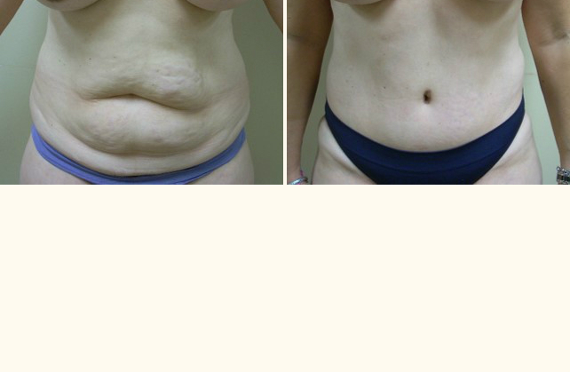 body tummy tuck 1505509213579