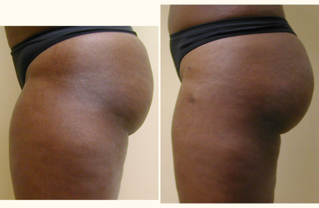 brazilian butt lift fat transfer buttlift 1 1381807653841