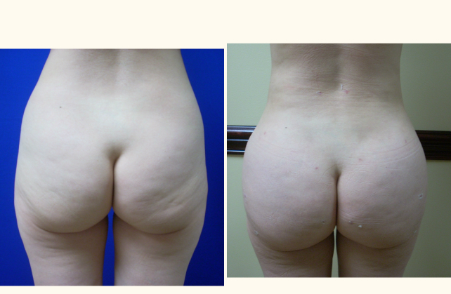 brazilian butt lift fat transfer empty procedure 1381806048000