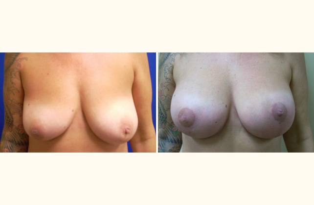 breast breast aug with lift patient 02