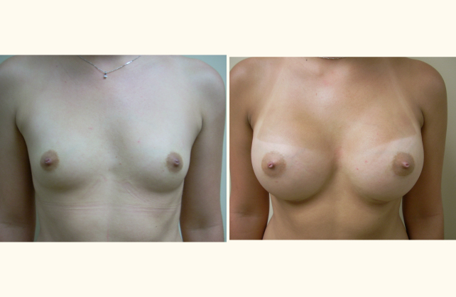 breast breast augmentation 1401740034565