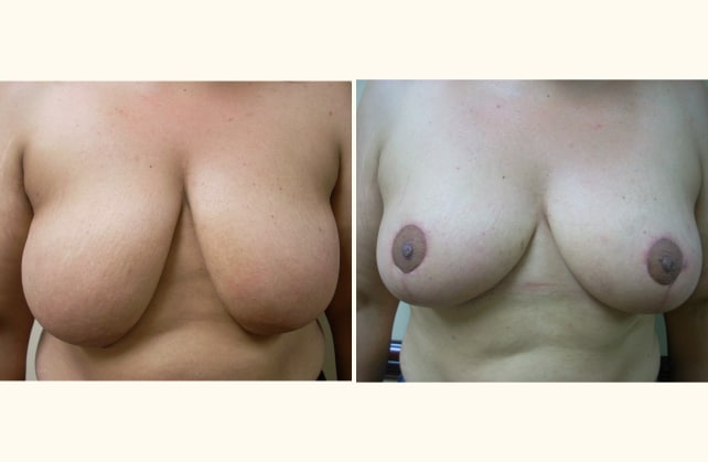 breast breast lift 1400711480688