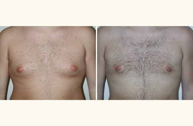 breast gynecomastia 1350497455838