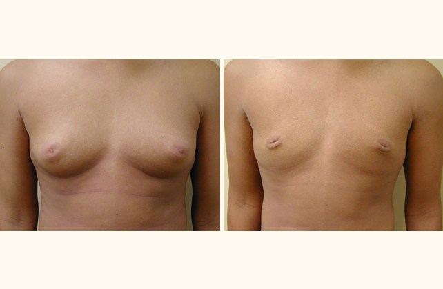 breast gynecomastia 1350497490869