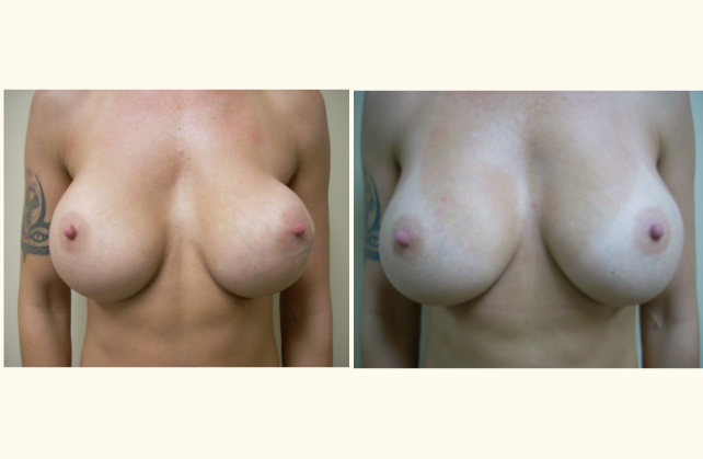 breast implant exchange 1444668623307