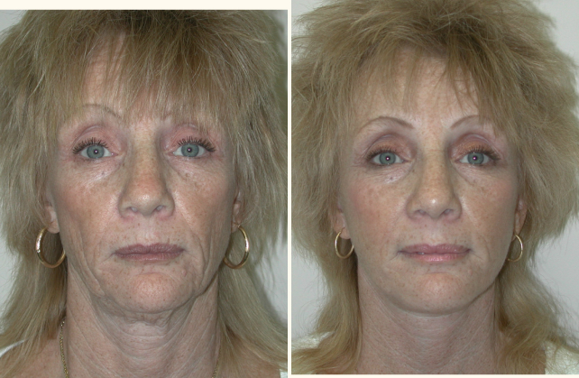 face facelift 1348622468874