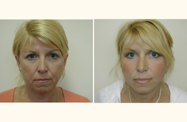 face facelift 1401480740877