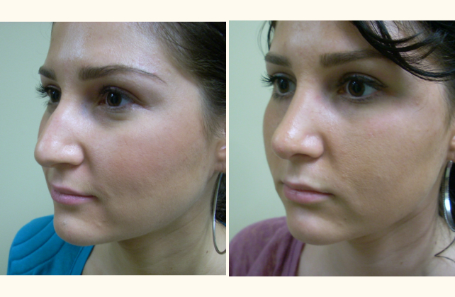 face rhinoplasty 1400882096327