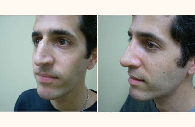 face rhinoplasty 1400884398321