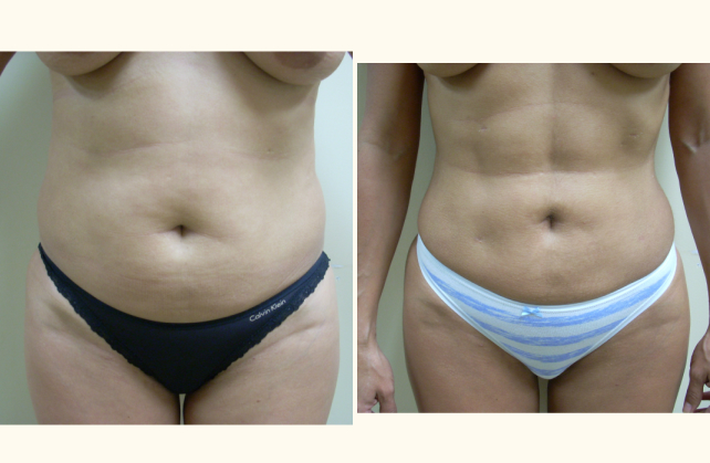 liposuction abdomen 1381796300770
