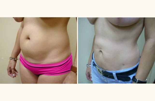 liposuction abdomen 1381796920066