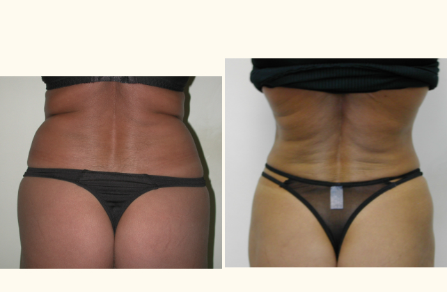 liposuction abdomen 1381801946618