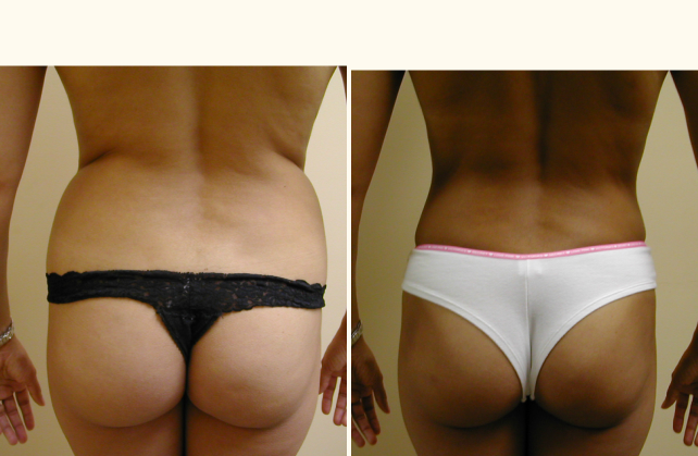 liposuction abdomen 1381802573416