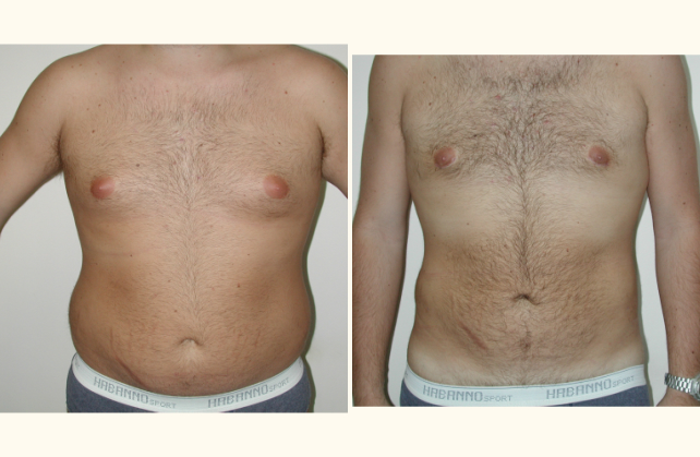 liposuction abdomen 1381808028037