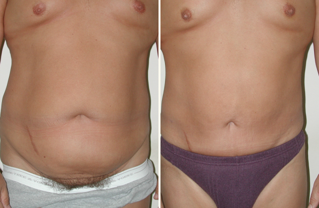 liposuction abdomen 1381808158229
