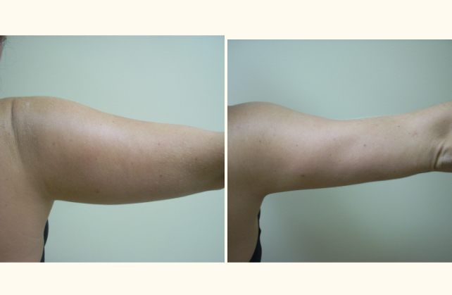 liposuction arms 1381803192830