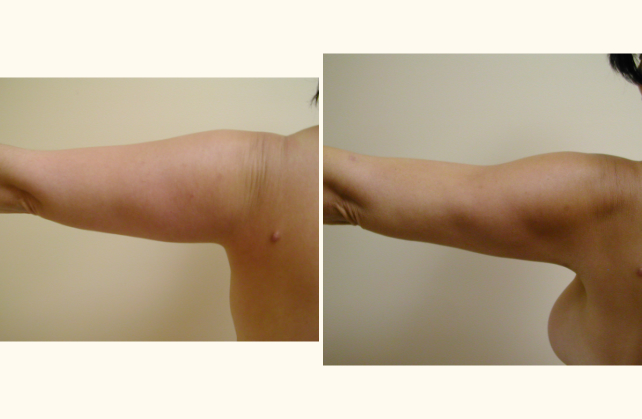 liposuction arms 1381803323406