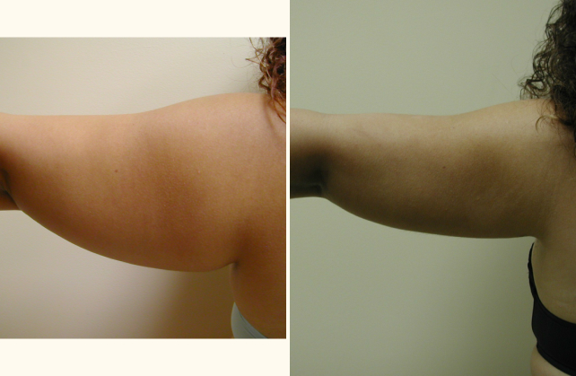 liposuction arms 1381803477730