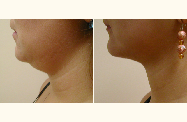 liposuction neck 1381803688635