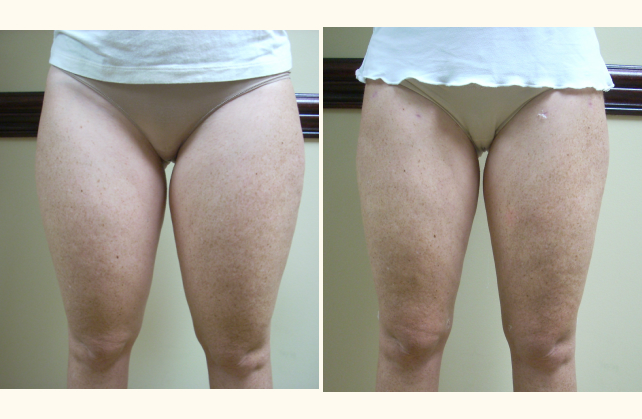 liposuction thighs 1381804987444