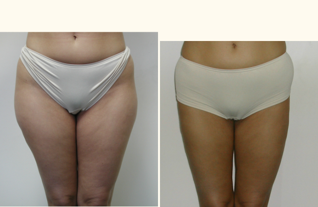 liposuction thighs 1381805230630