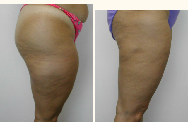 liposuction thighs 1381805395037