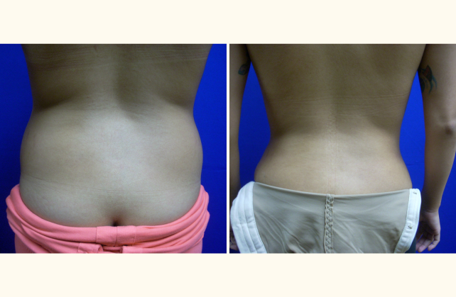 liposuction tummy waist female 1415852933200
