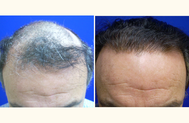 neograft hair transplant neograft 1401483548817