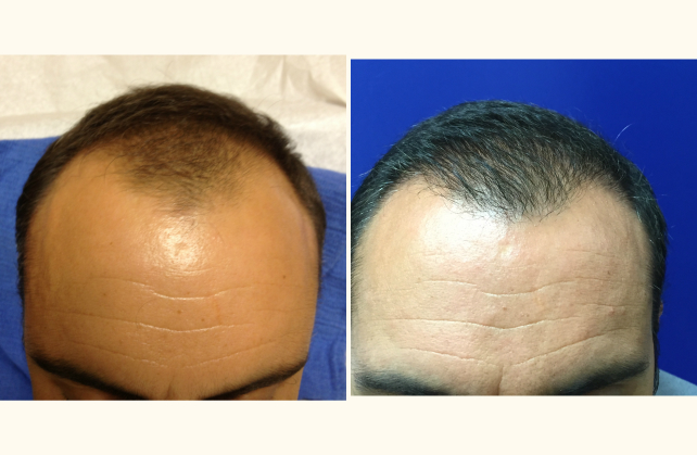 neograft hair transplant neograft 1436315023368