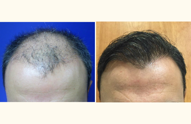 neograft hair transplant neograft 1463928256887