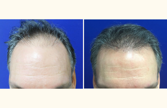 neograft hair transplant neograft 1463932173348