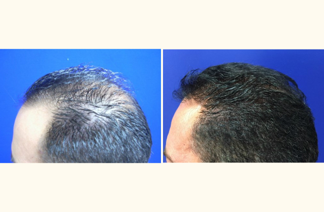 neograft hair transplant neograft 1463943211136