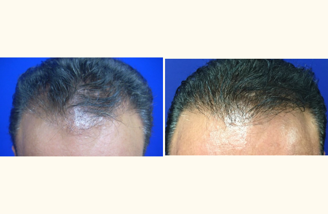 neograft hair transplant neograft 1463943359944