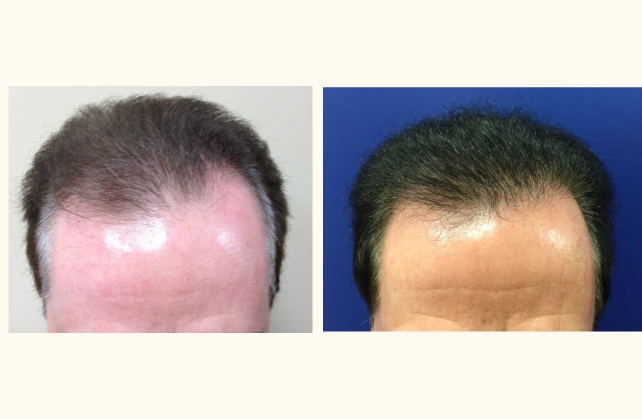 neograft hair transplant neograft 1463945281033