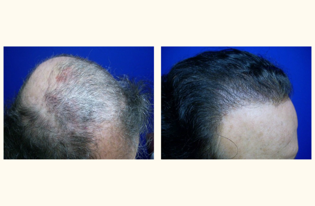 neograft hair transplant neograft 1463945959222