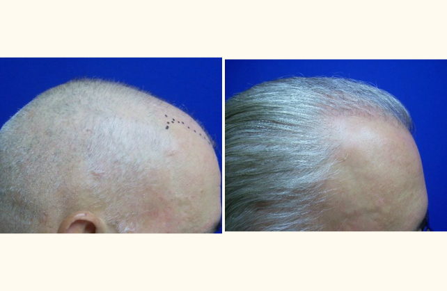 neograft hair transplant neograft 1463948120563