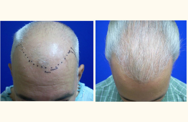 neograft hair transplant neograft 1463948199280