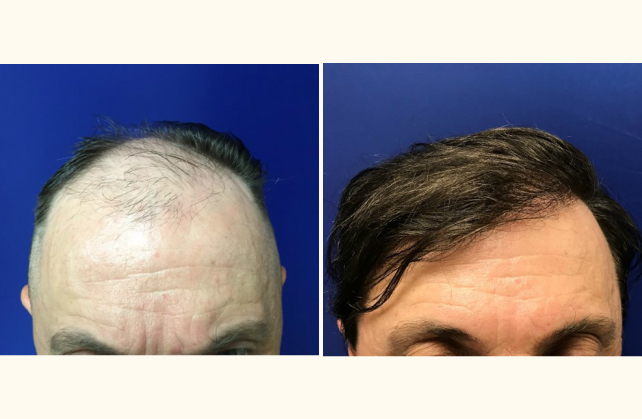 neograft hair transplant neograft 1505504036255