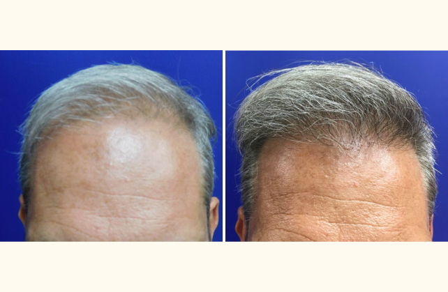 neograft hair transplant neograft 1505504185263