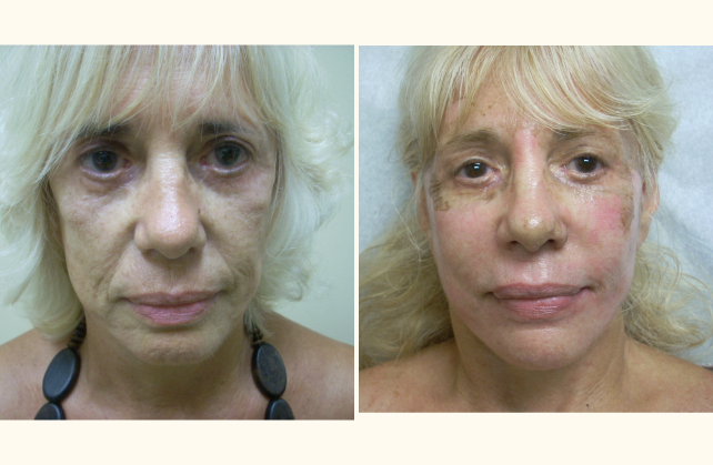 non surgical facial enhancement fat transfer grafting to face 1415906417566
