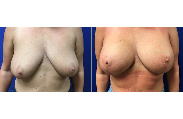 augpexy case 8 fr pre post