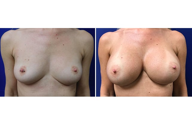 breast aug fr case 15 pre post