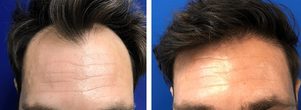 neograft hair transplant case 14