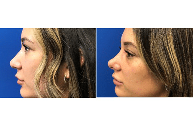 rhinoplasty case 6 lat both